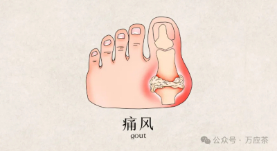 痛风简介及痛风容易与哪些疾病混淆