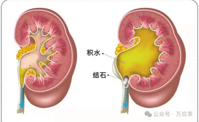 什么是肾积水
